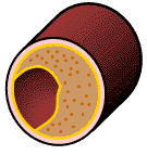 Bild arteriosklerotisch verändertes Blutgefäß
